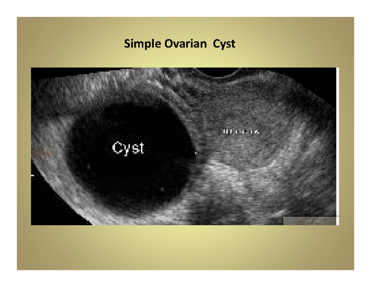 GYN II Lecture Presentation 1 Masses IUD's SON1122 Simple