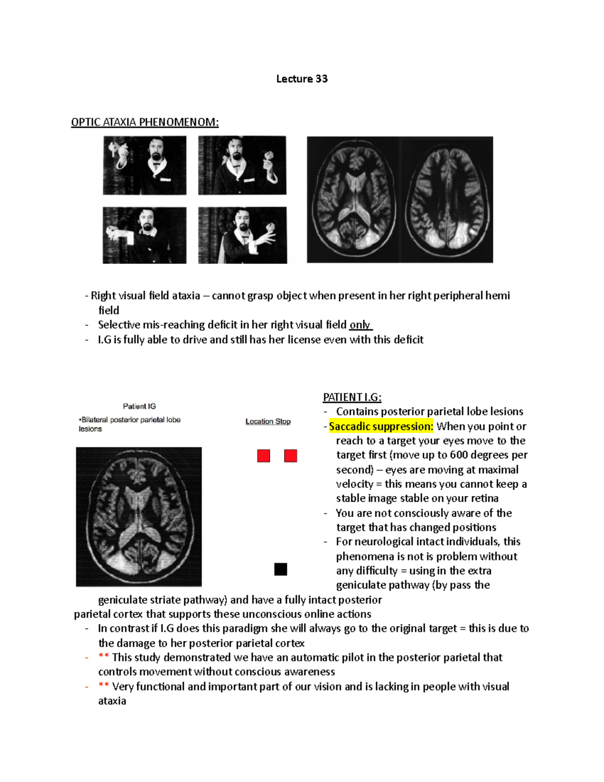 Lecture 33 Notes Lecture 33 OPTIC ATAXIA PHENOMENOM Right visual