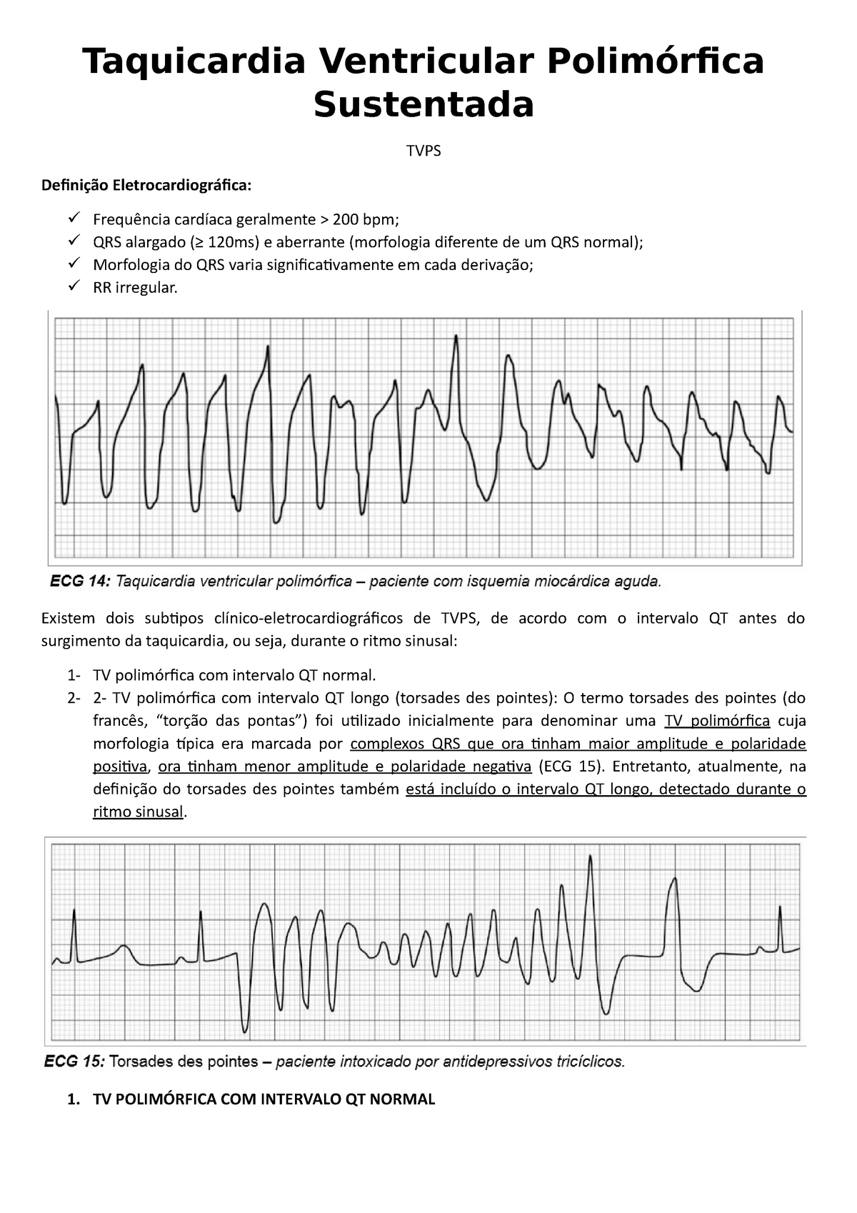 taquicardia ventricular polimórfica