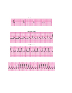 Systolic Murmurs - heart notes - SYSTOLIC MURMURS between S1 and S ...