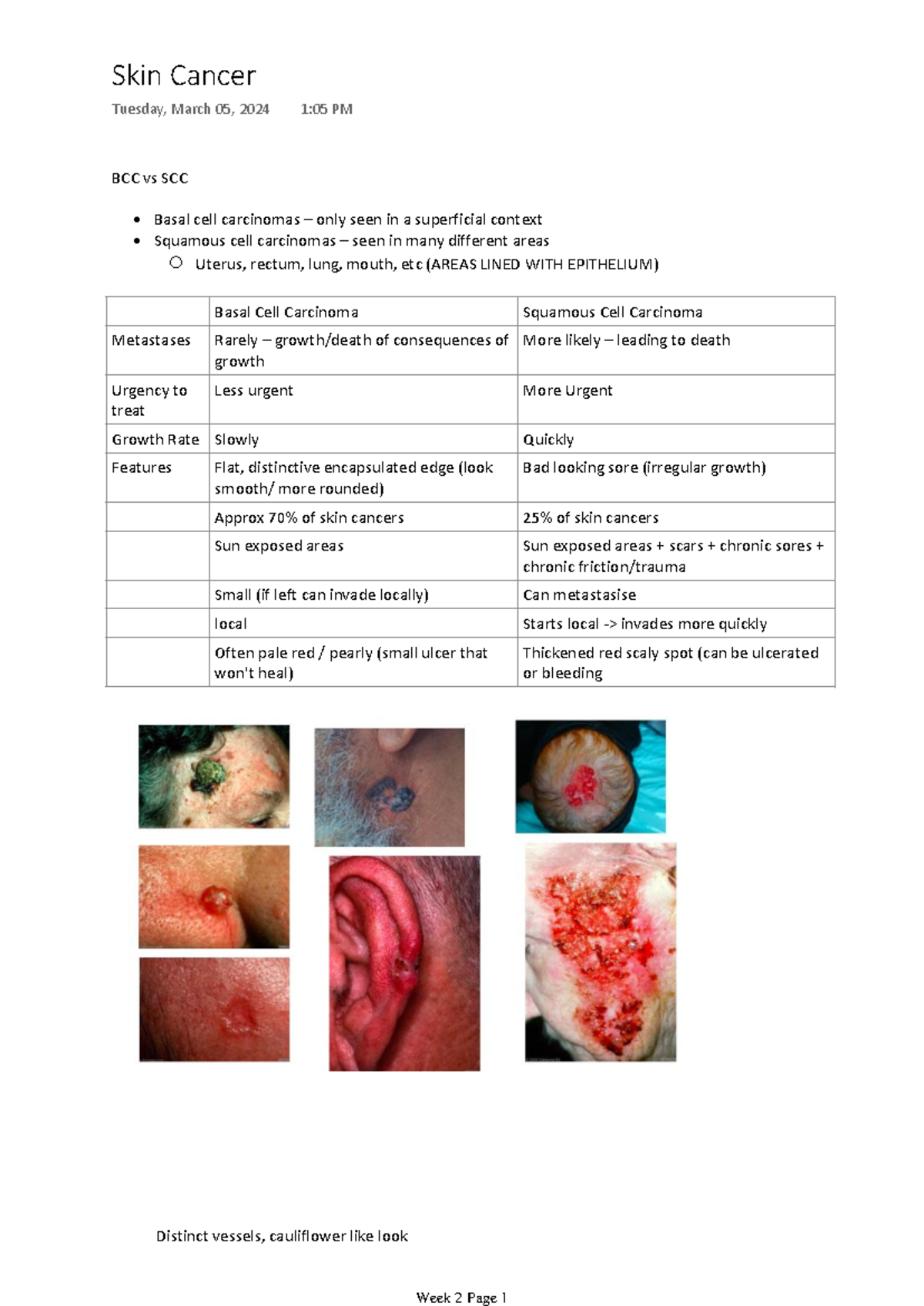 Surface Radiation Therapy - BCC vs SCC • Basal cell carcinomas – only ...