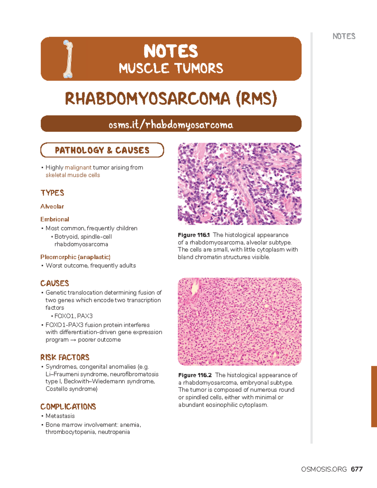 Muscle tumors - musculoskeletal course -MEDICINE - OSMOSIS NOTES 677 ...