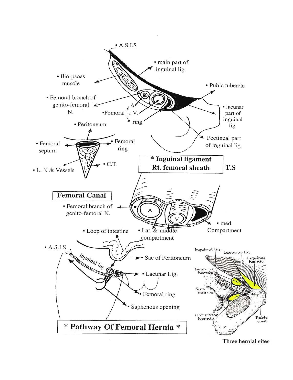 Femoral Hernia Advanced Anatomy And Surgery Summary With Atlas Femoral Hernia Incidence 7468