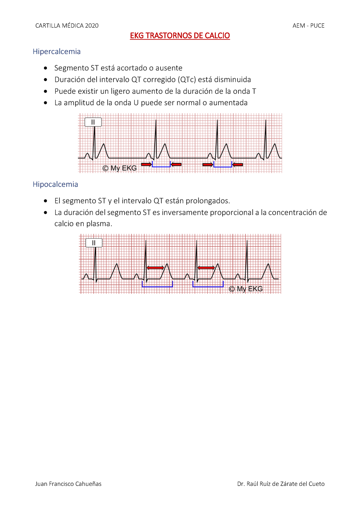 electrocardiograma de hipercalcemia