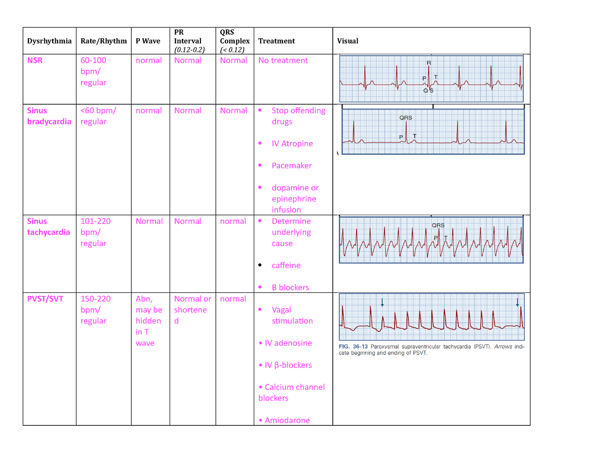 Ekg Review - Dysrhythmia Rate Rhythm P Wave Pr Interval (0.12-0) Qrs 