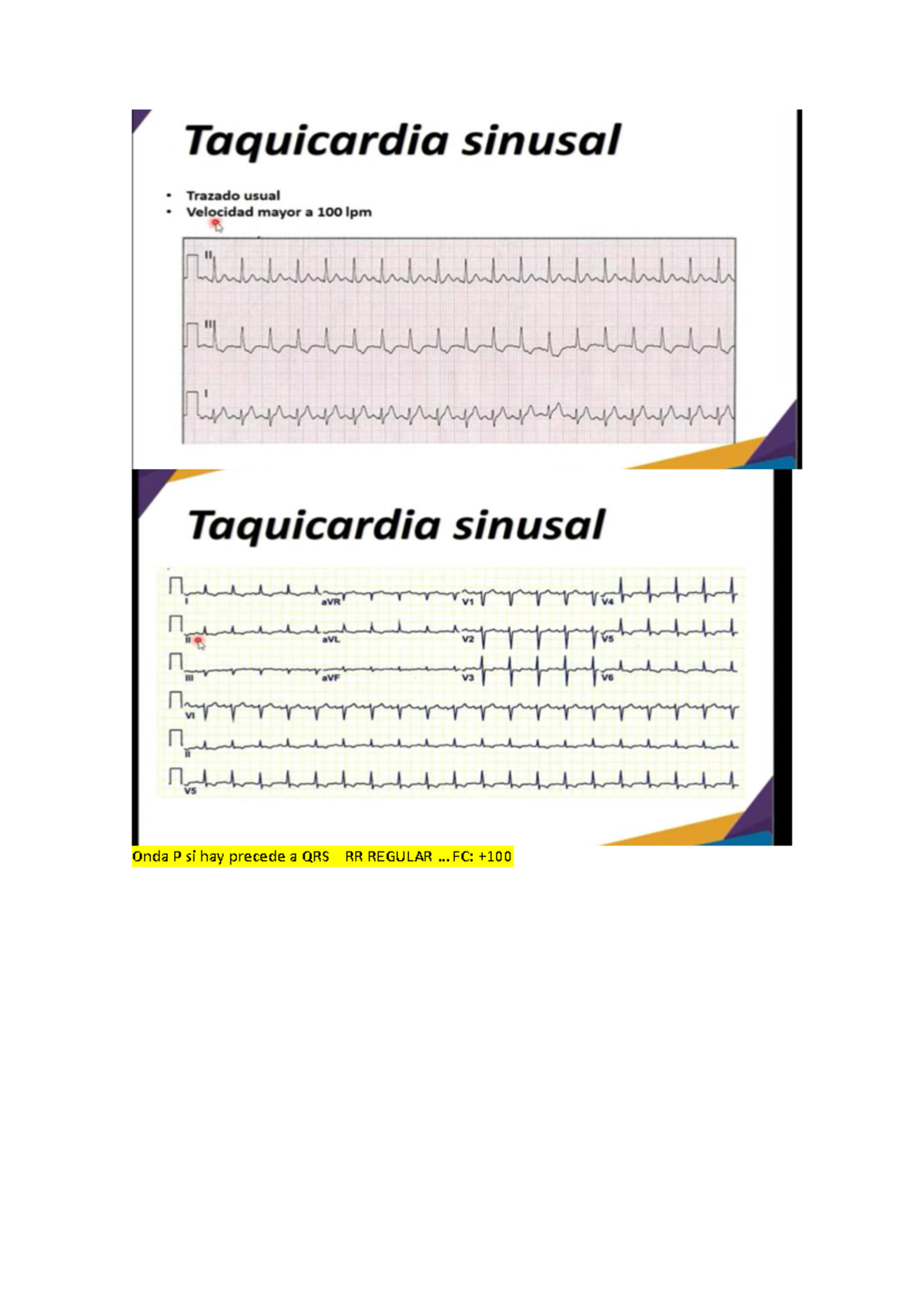 EKG - ekgd - Onda P si hay precede a QRS RR REGULAR FC: + NO HAY ONDA P ...