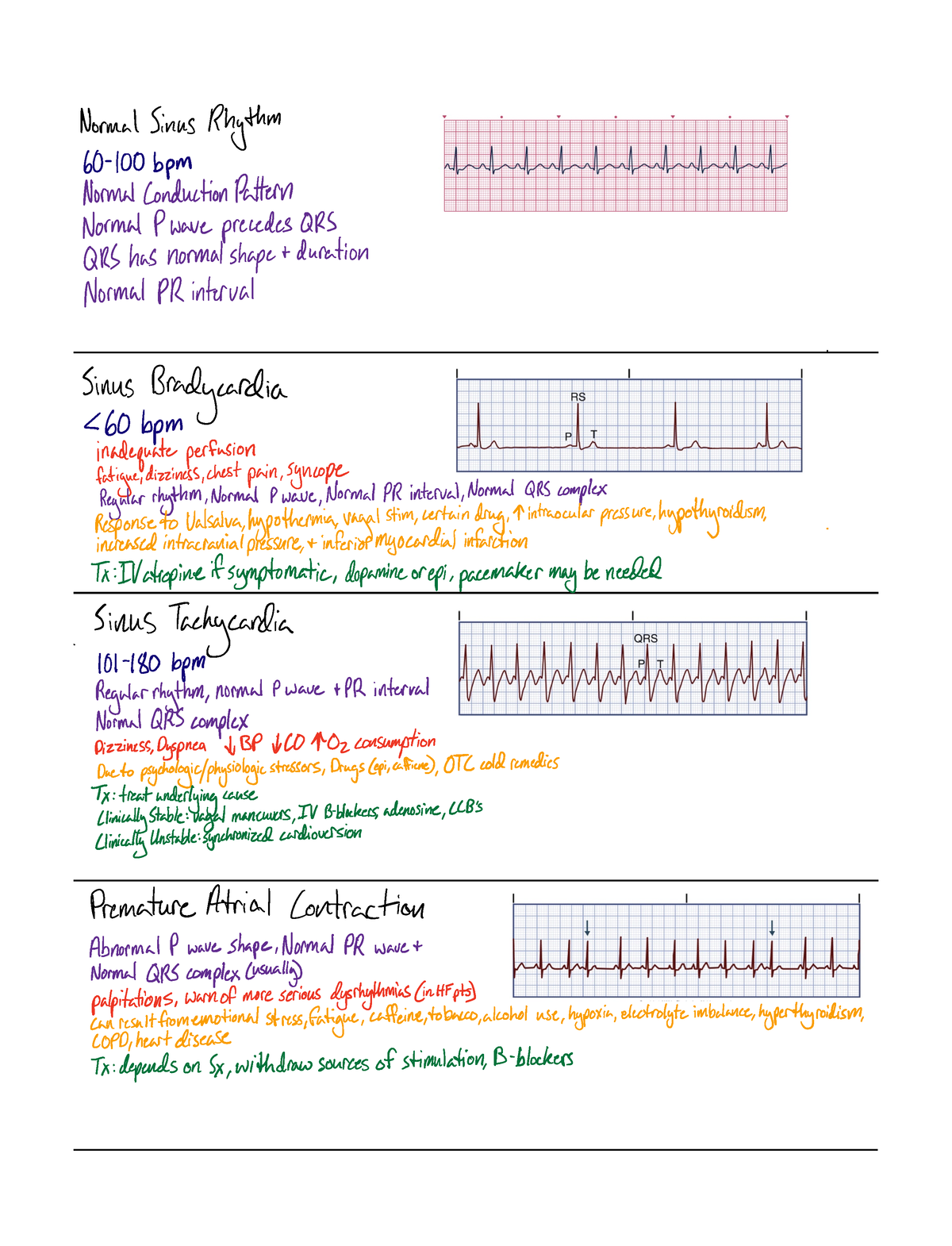 EKG Dysrhythmias - ormalSinusRhythm 0 100bpm ormalConductionPattern ...