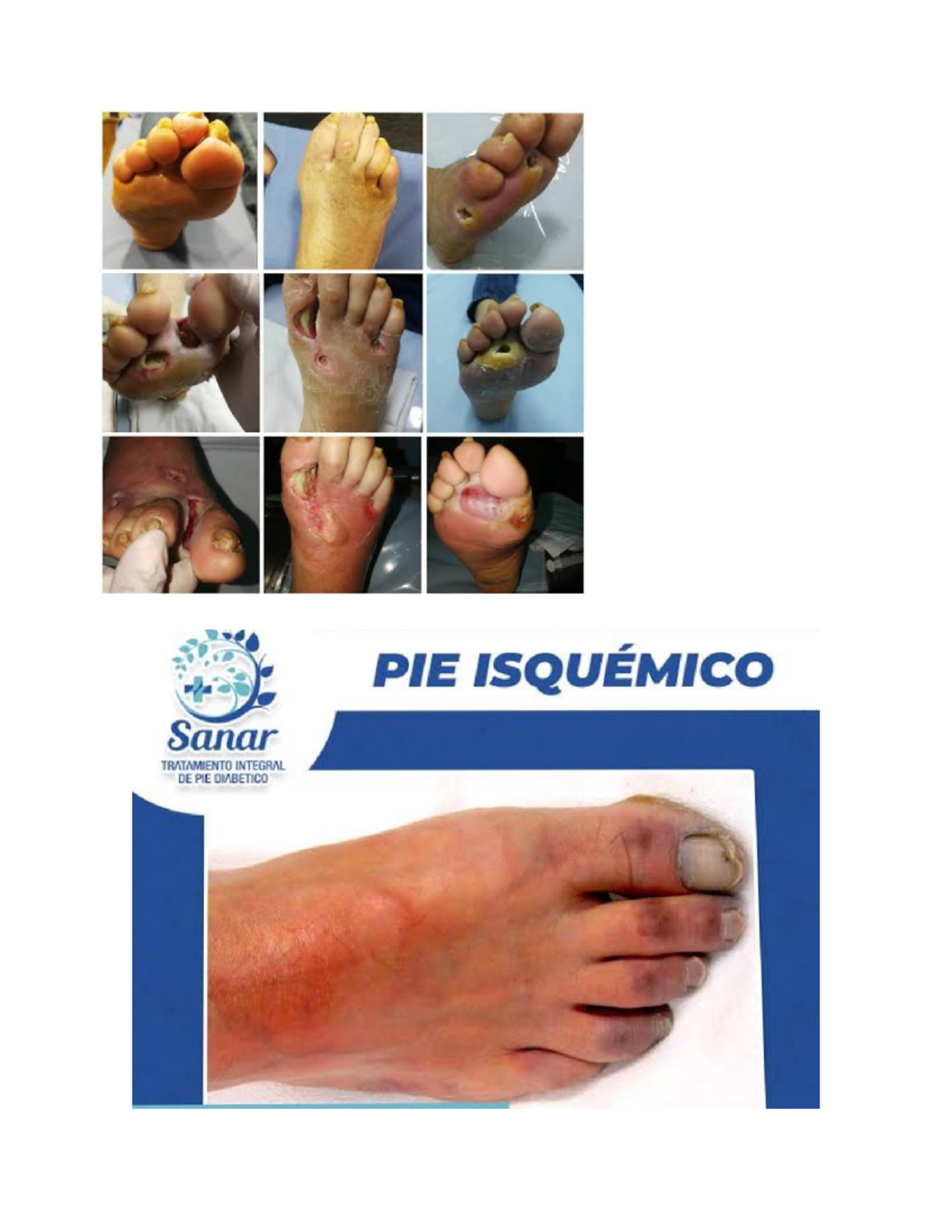 Pie diabetico enfermeria comunitaria PIE ISQUÉMICO Sanar