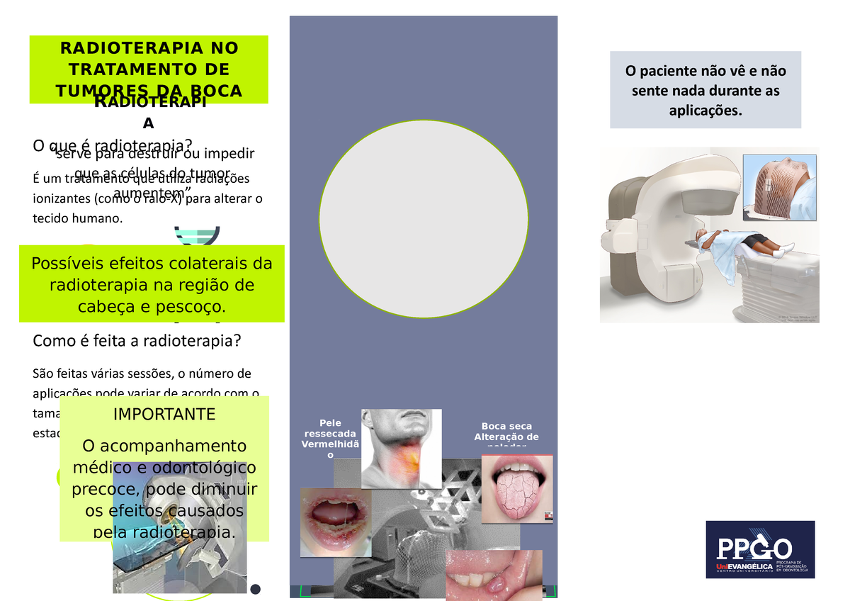 Radioterapia No Tratamento De Tumores Da Boca RADIOTERAPIA NO TRATAMENTO DE TUMORES DA BOCA O