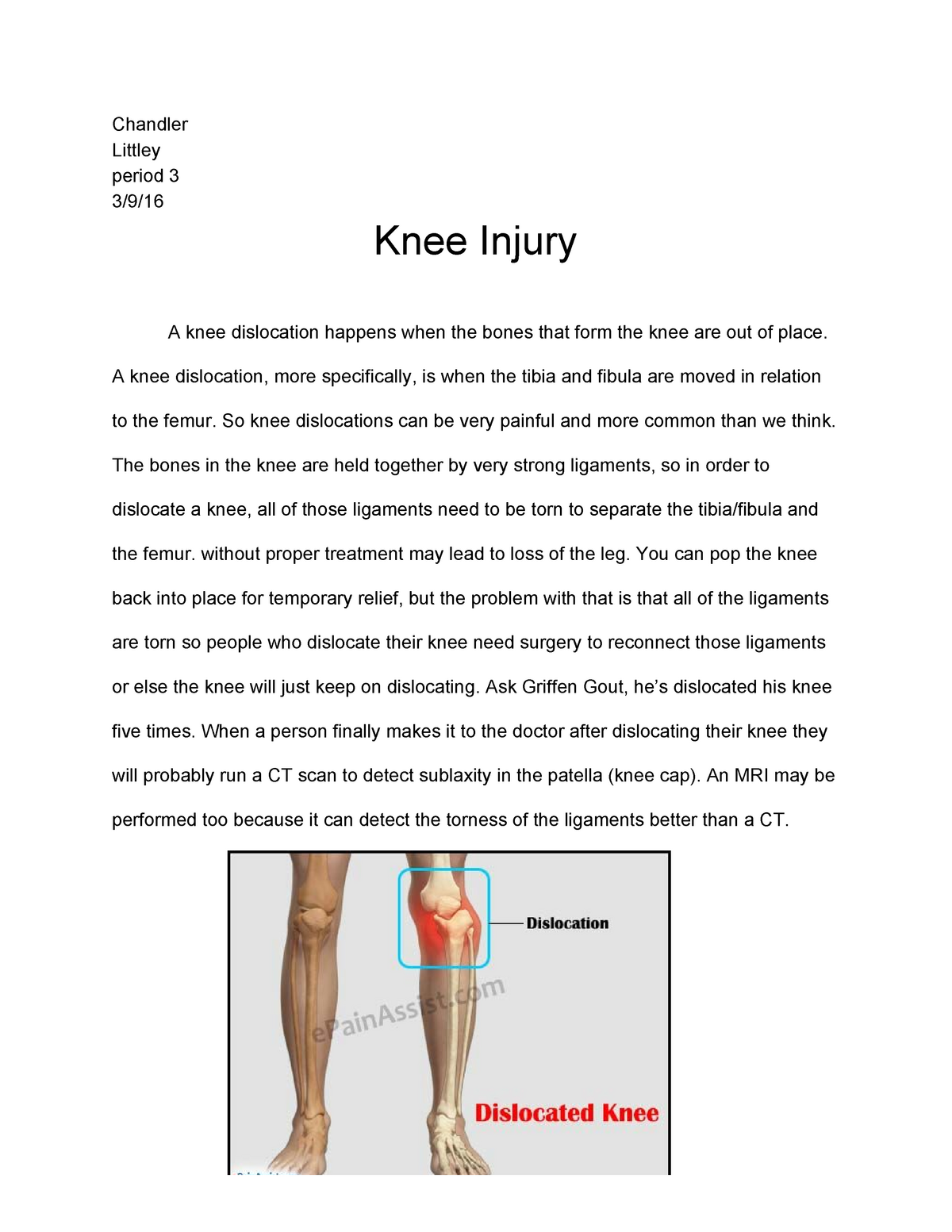 dislocated knee and torn ligaments