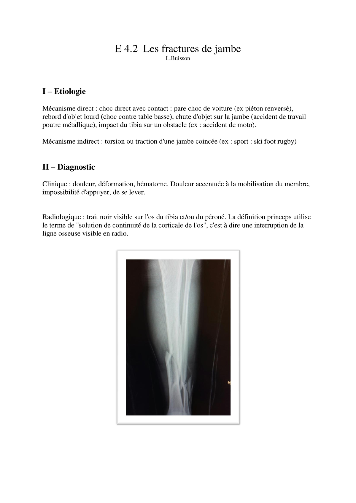 Fractures-de-jambe - bien - E 4 Les fractures de jambe L I ...