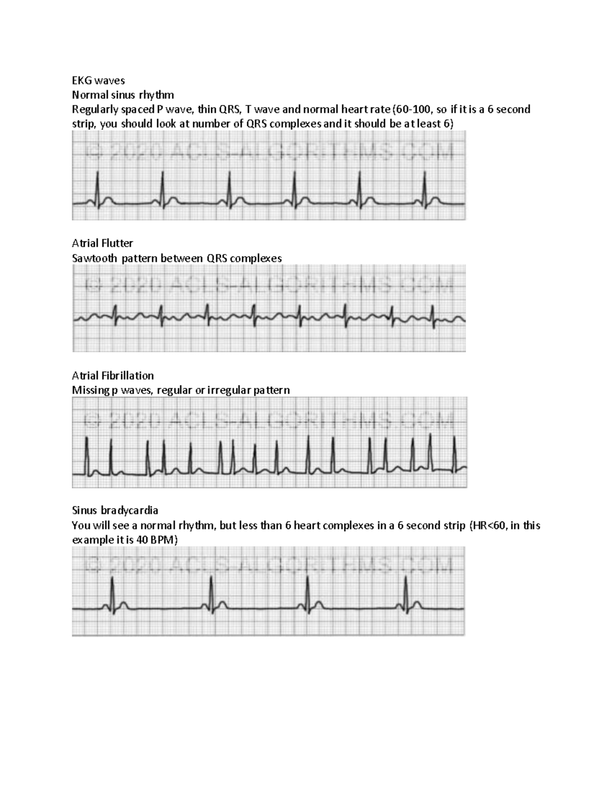 Ekg - Ekg practice - EKG waves Normal sinus rhythm Regularly spaced P ...