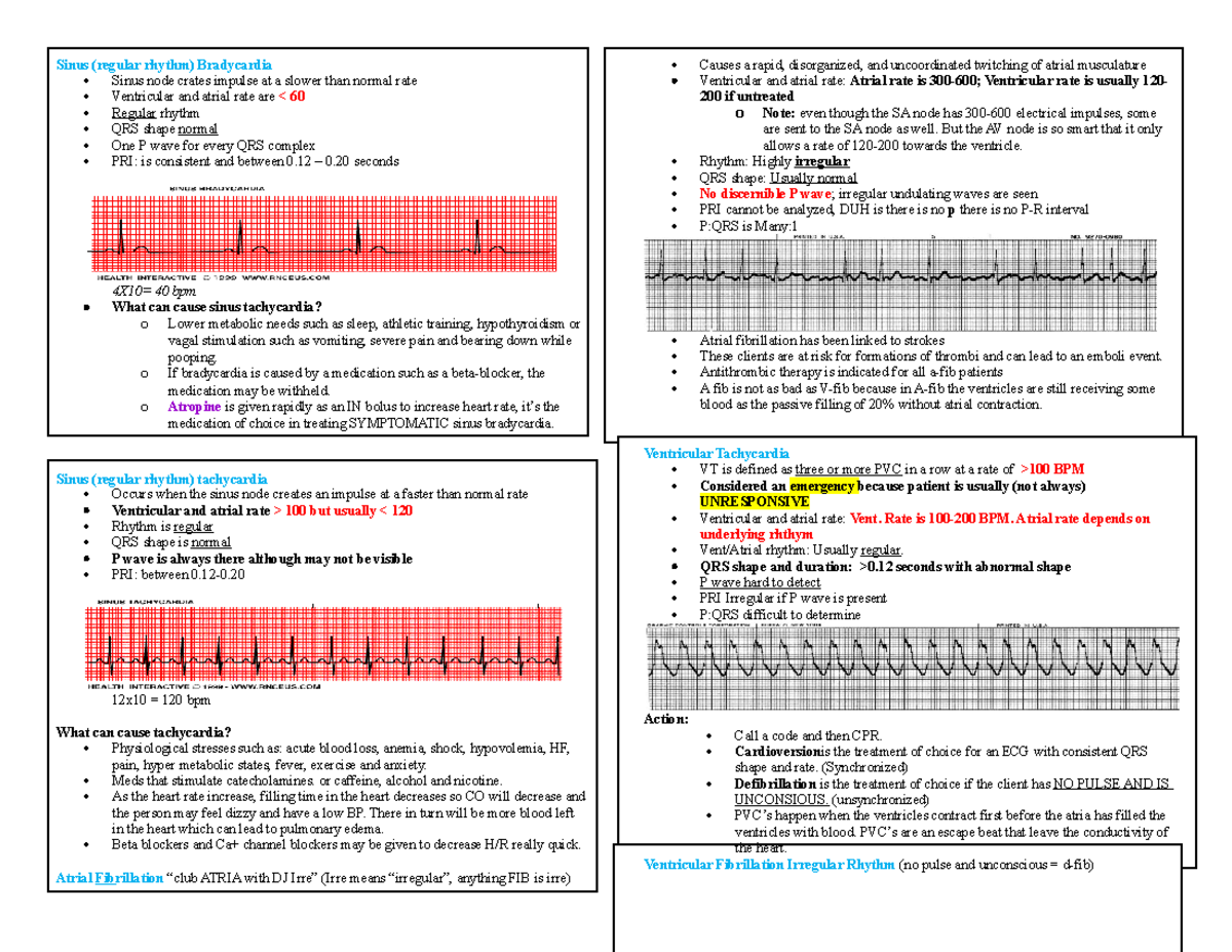 Dysrthmias 2 - dysrhythmiA - Sinus (regular rhythm) Bradycardia Sinus ...