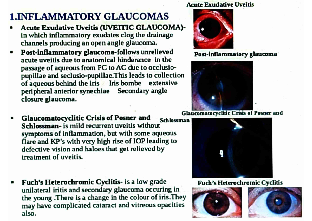 Glaucoma detailed note 4 - Acute Exudative Uveitis 1. INFLAMMATORY ...