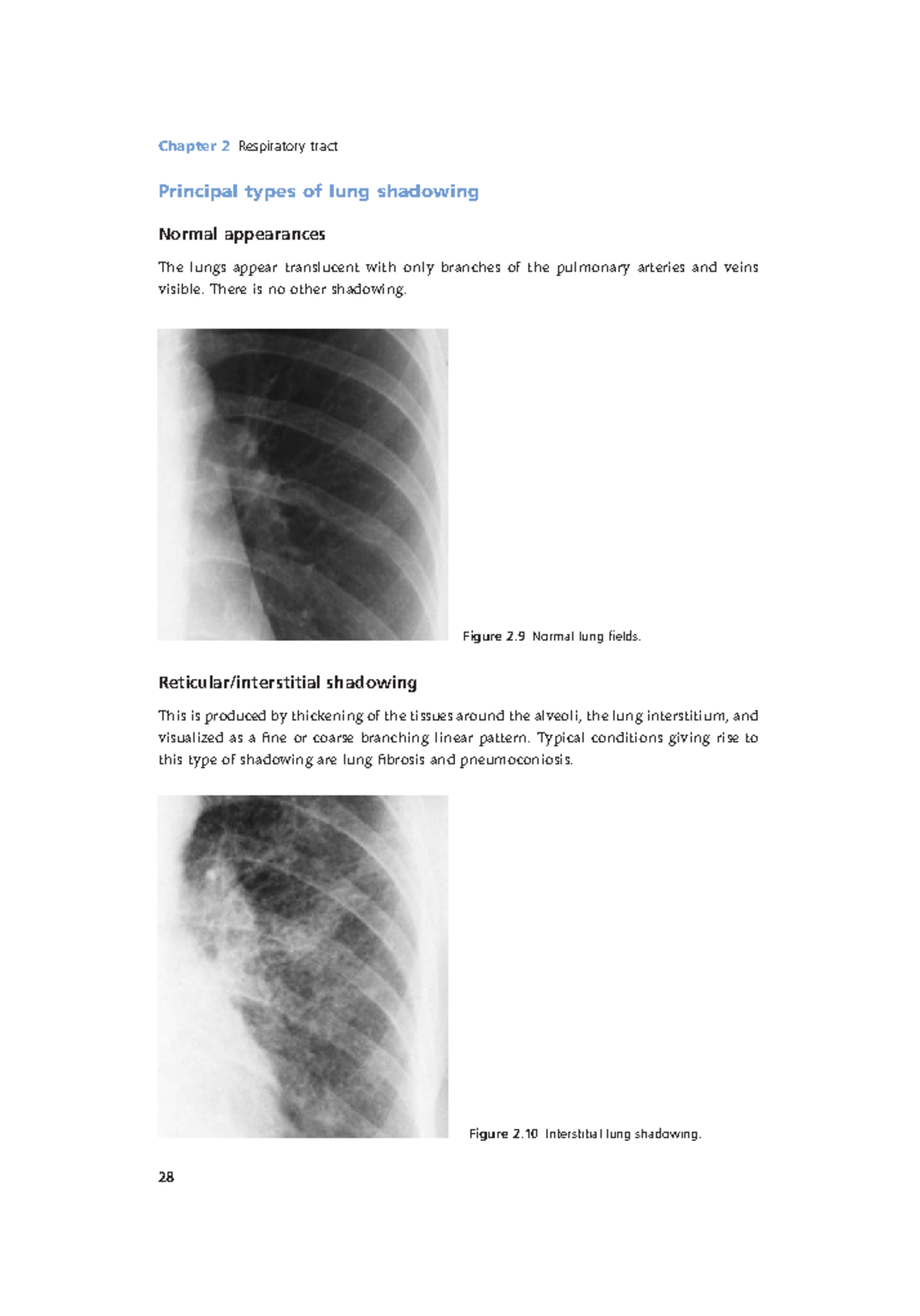 Radiology Lecture Notes Pdf (10) - Chapter 2 Respiratory Tract 28 