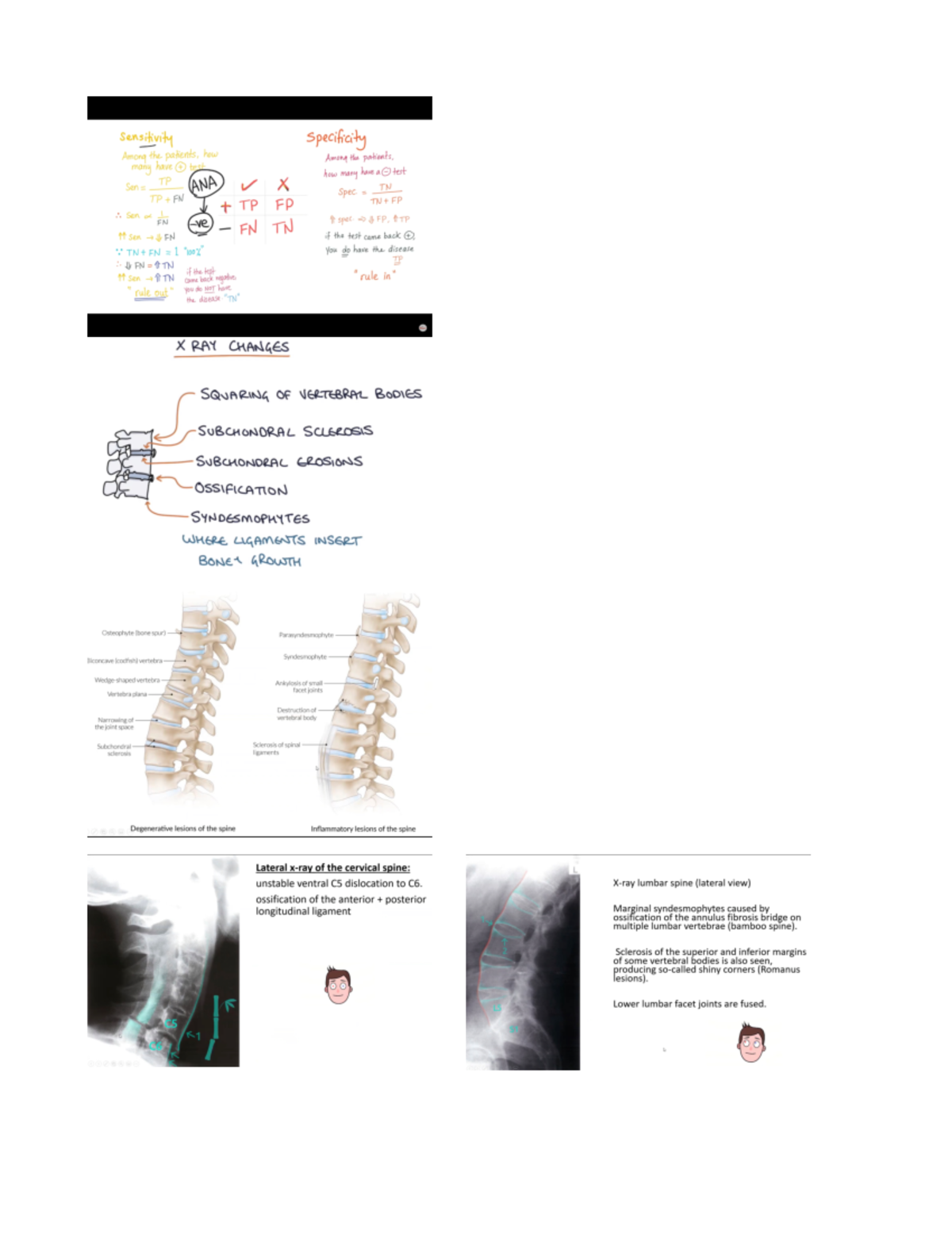 Rheumatology- Ankylosing Spondylitis - MEDI1031 - Studocu