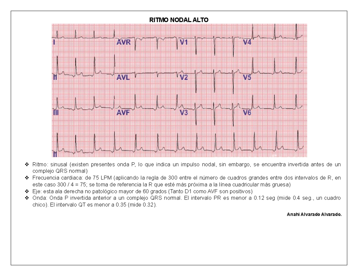Manual EKG - RITMO NODAL ALTO Ritmo: sinusal (existen presentes onda P ...