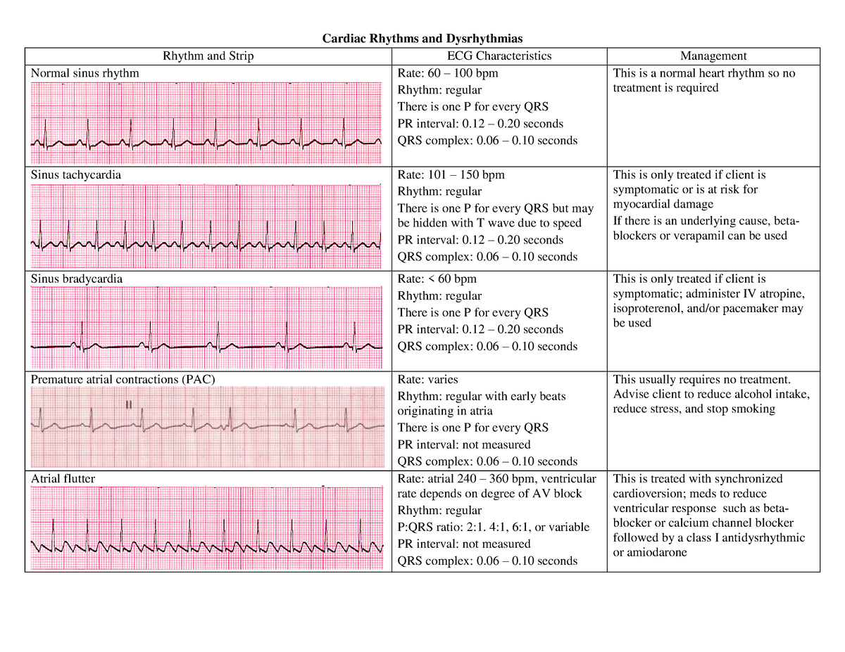 CardiacDysrhythmias for heart patients Cardiac Rhythms and