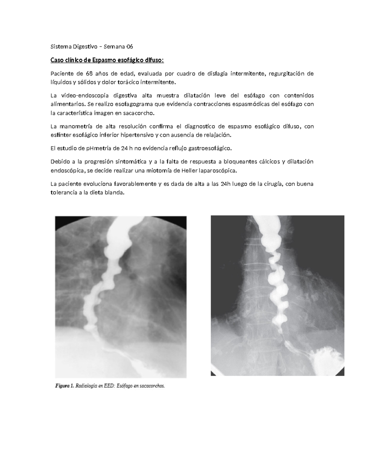 Espasmo esofágico difuso - Sistema Digestivo – Semana 06 Caso clínico ...