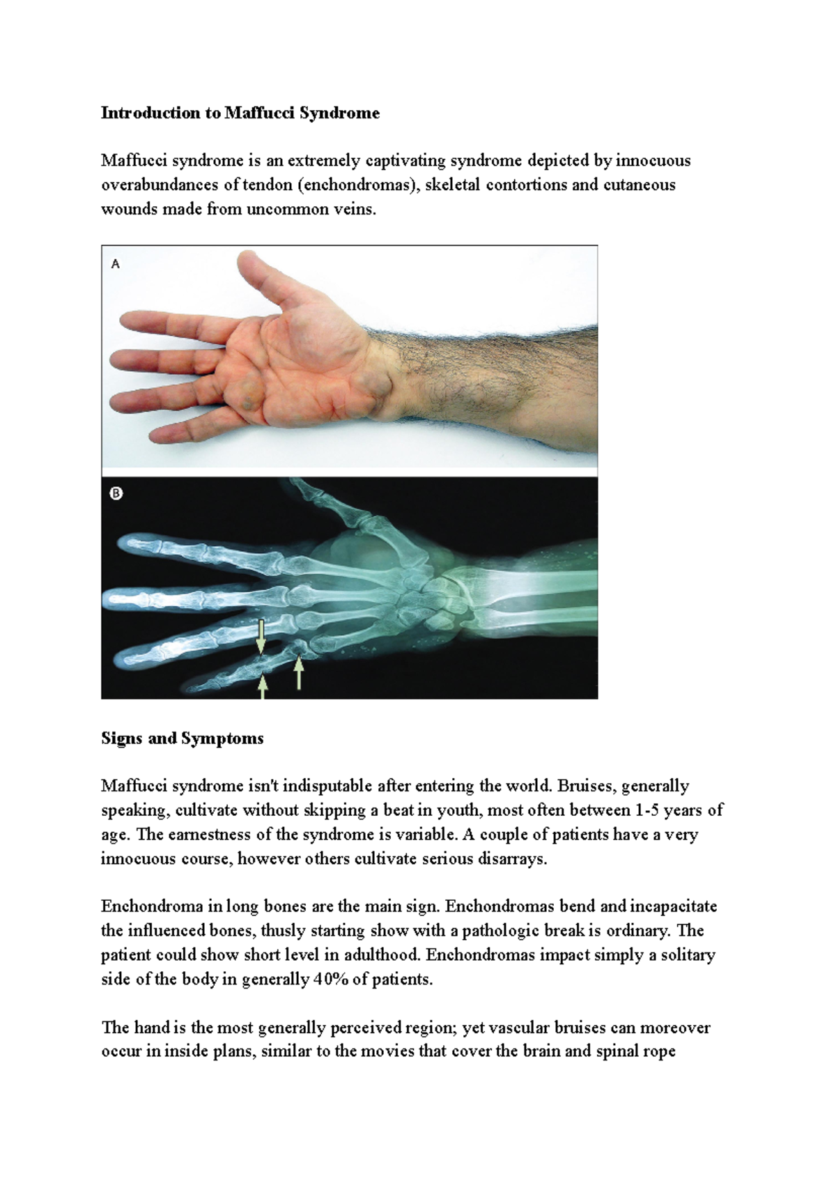Maffucci Syndrome - Introduction to Maffucci Syndrome Maffucci syndrome ...