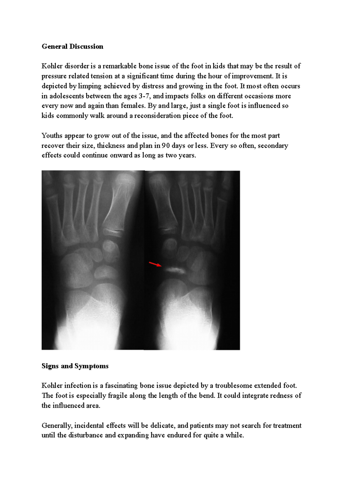 Kohler Disorder General Discussion Kohler disorder is a remarkable
