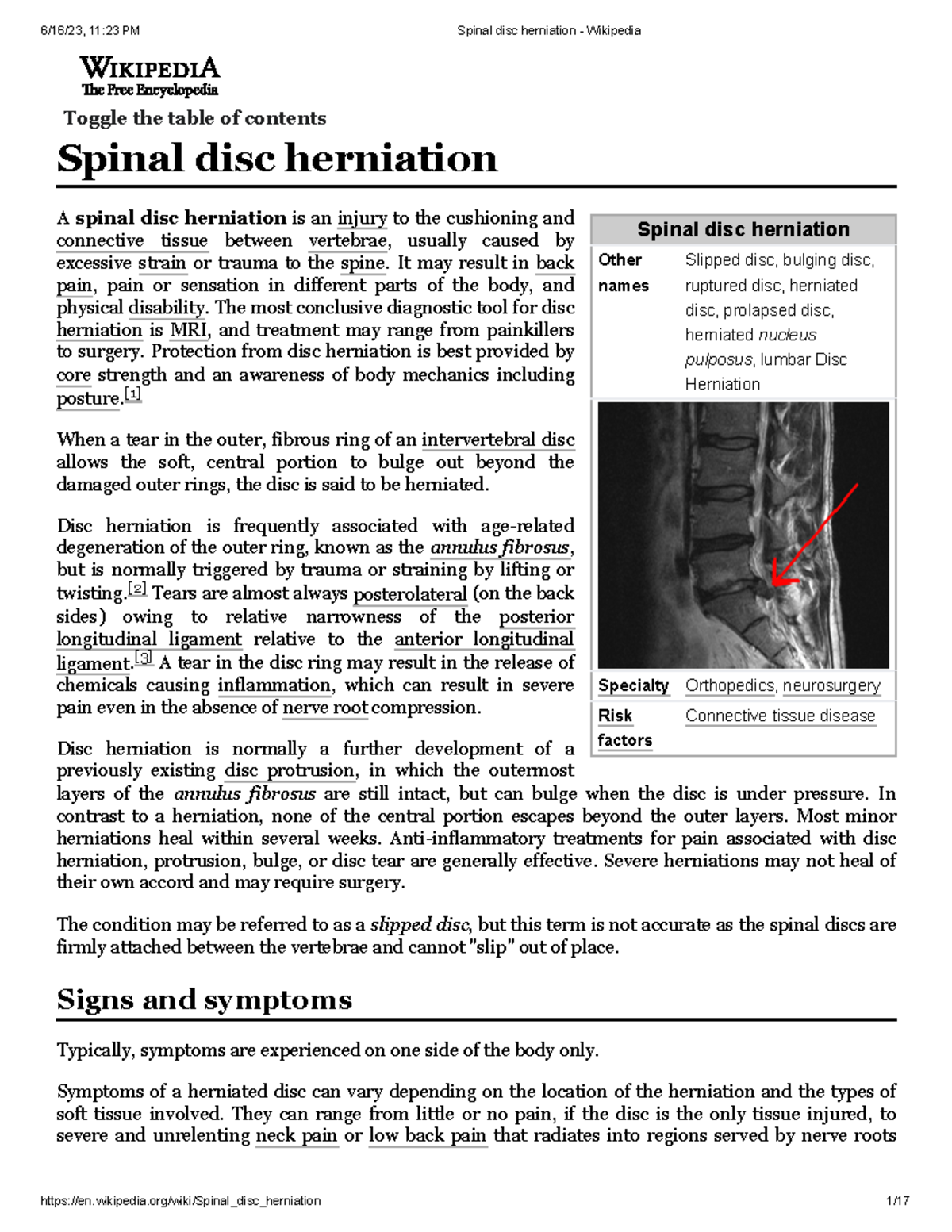 Spinal disc herniation - It may result in back pain, pain or sensation ...