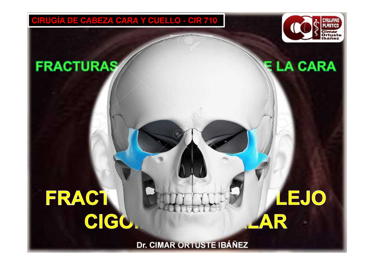 5 Tema 5 Fracturas Del Complejo Cigomático Malar CirugÍa De Cabeza Cara Y Cuello Cir 710 7539