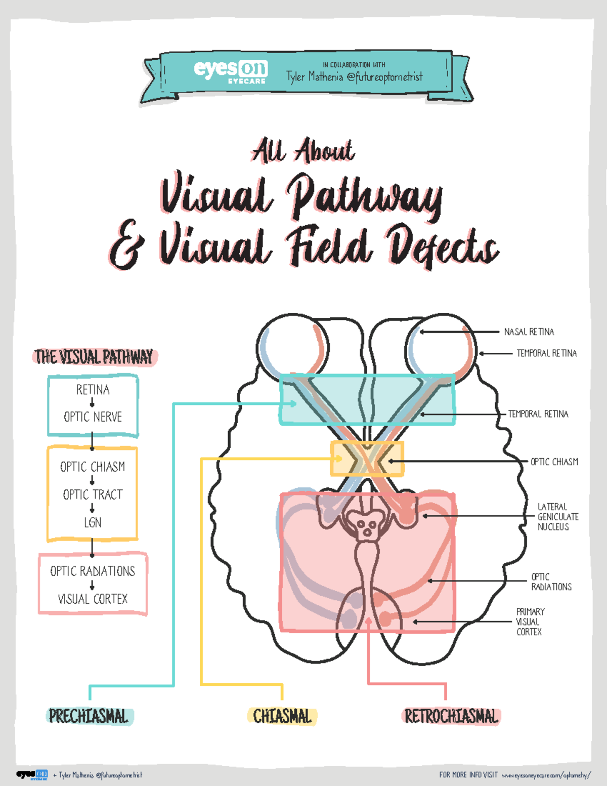 Visual Pathway & Visual Field Defects - THE VISUAL PATHWAY PRECHIASMAL ...