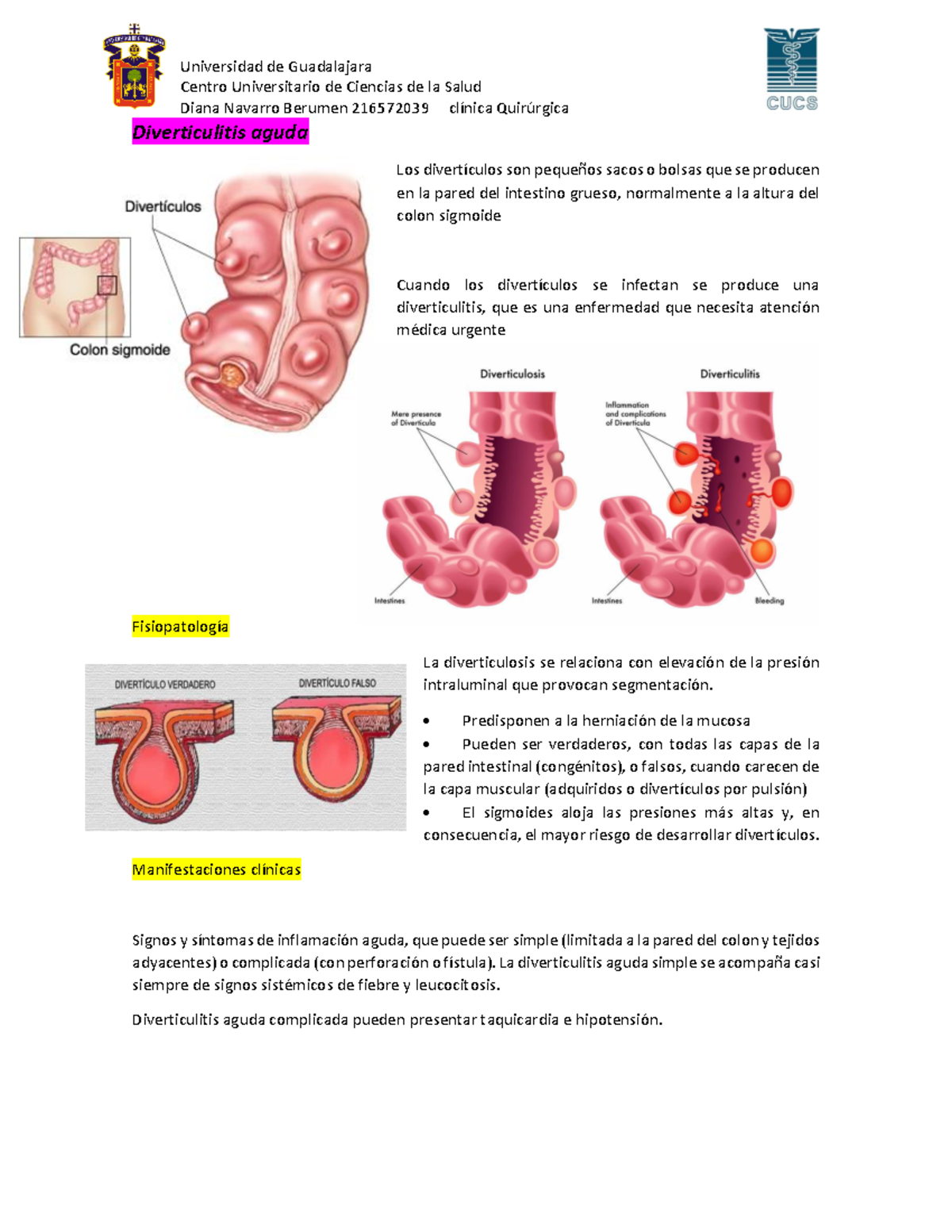 Diverticulitis Aguda Universidad De Guadalajara Centro Universitario