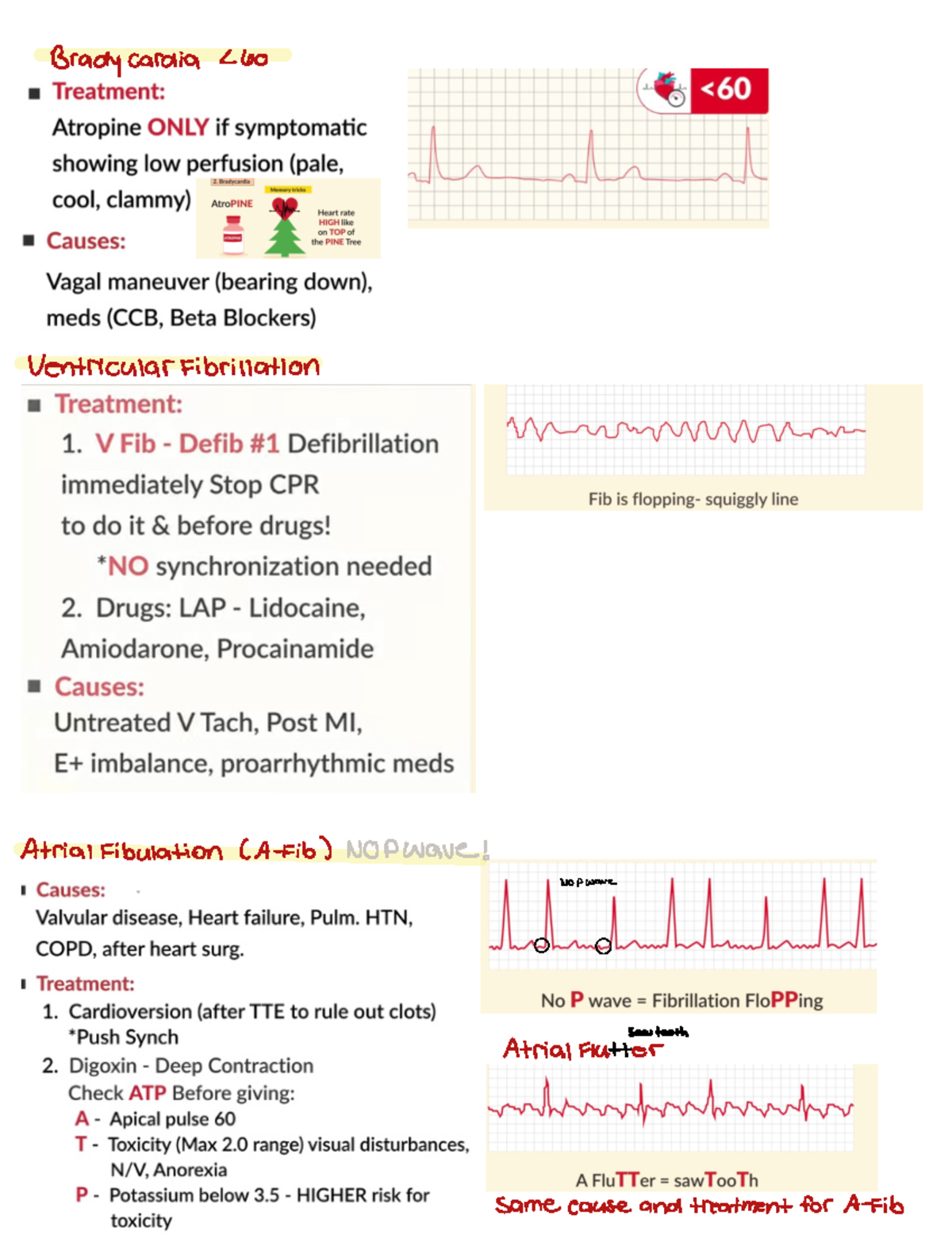 Cardiac Nclex - Bradycardia 260 Ventricular Fibrillation Atrial ...