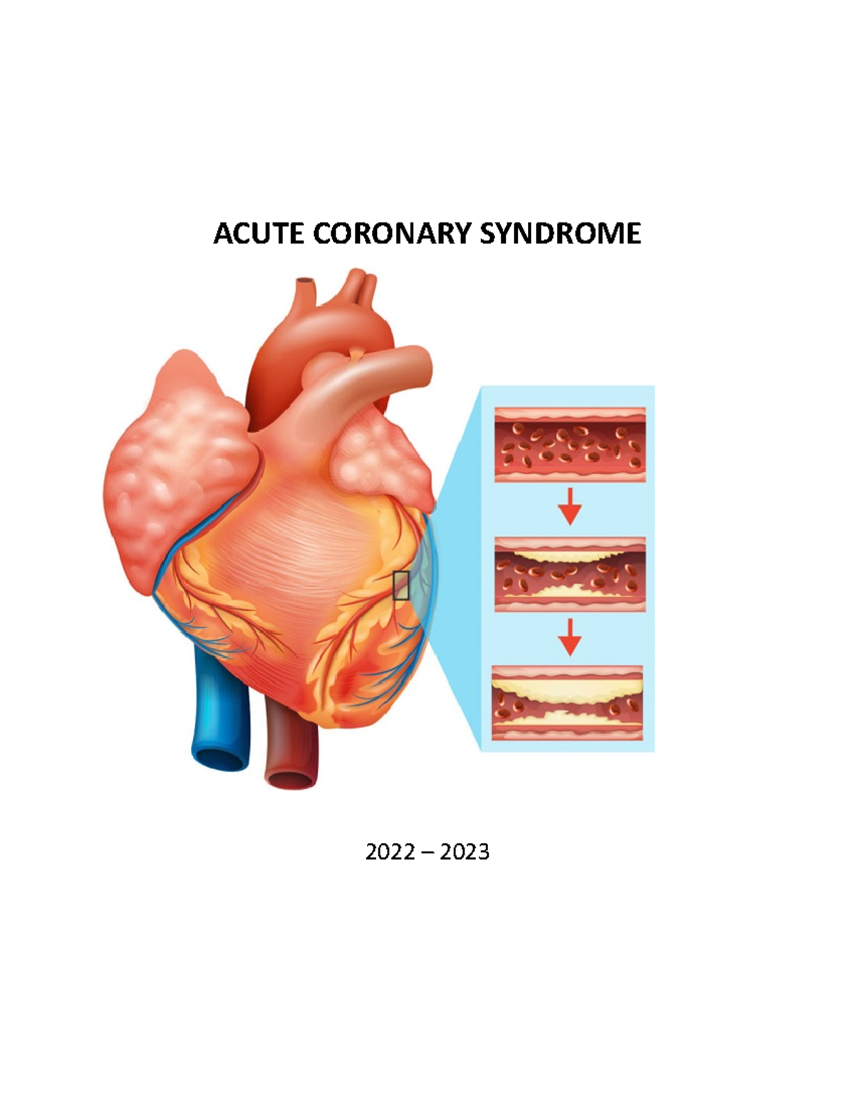 Acute Coronary Syndrome - ACUTE CORONARY SYNDROME 2022 – 2023 A variety ...