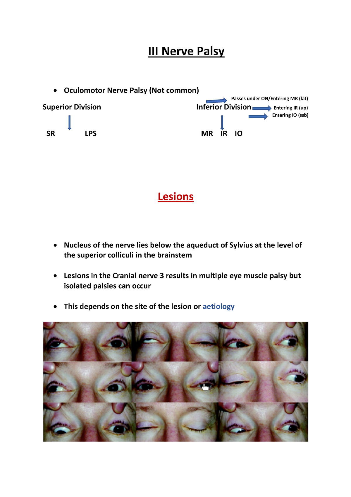 3rd-nerve-palsy-iii-nerve-palsy-oculomotor-nerve-palsy-not-common