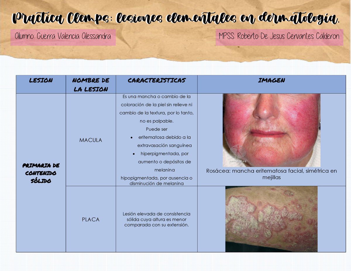 Cuadro Lesiones Elementales Dermatologicas LESION NOMBRE DE LA LESION CARACTERISTICAS IMAGEN