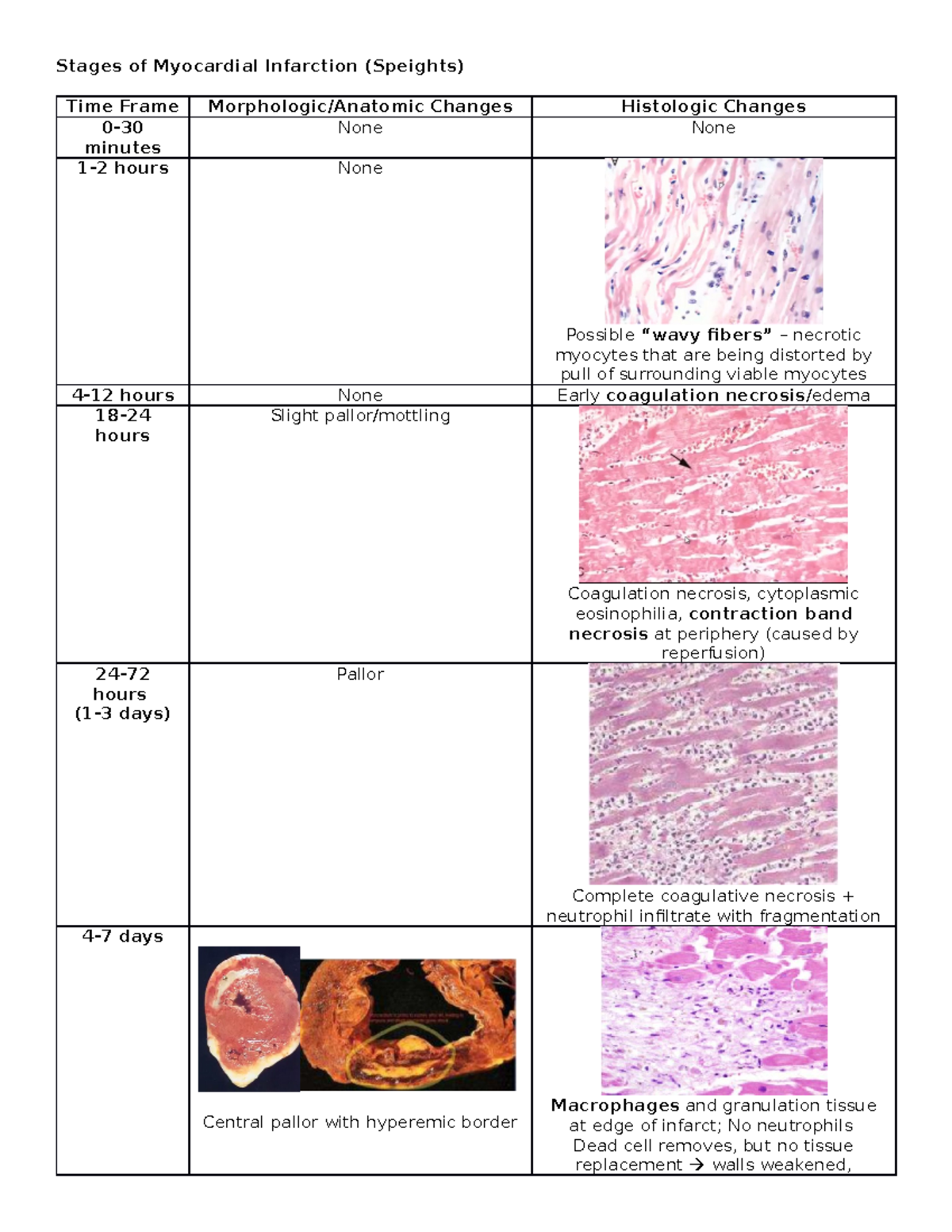 Stages of Myocardial Infarction (Speights) - Studocu