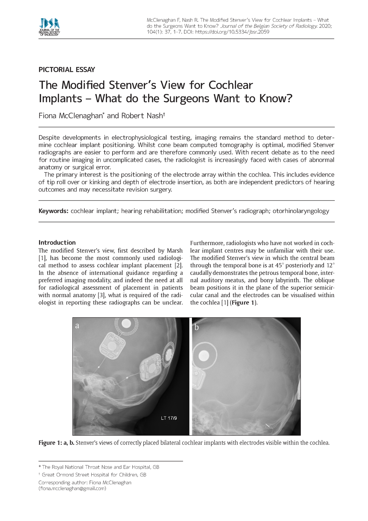 The Modified Stenvers View For Cochlear Implants - Introduction The ...