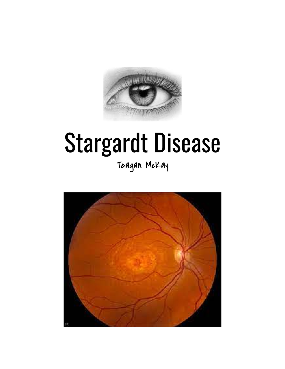 Stargardt Disease Stargardt Disease Teagan McKay Overview and