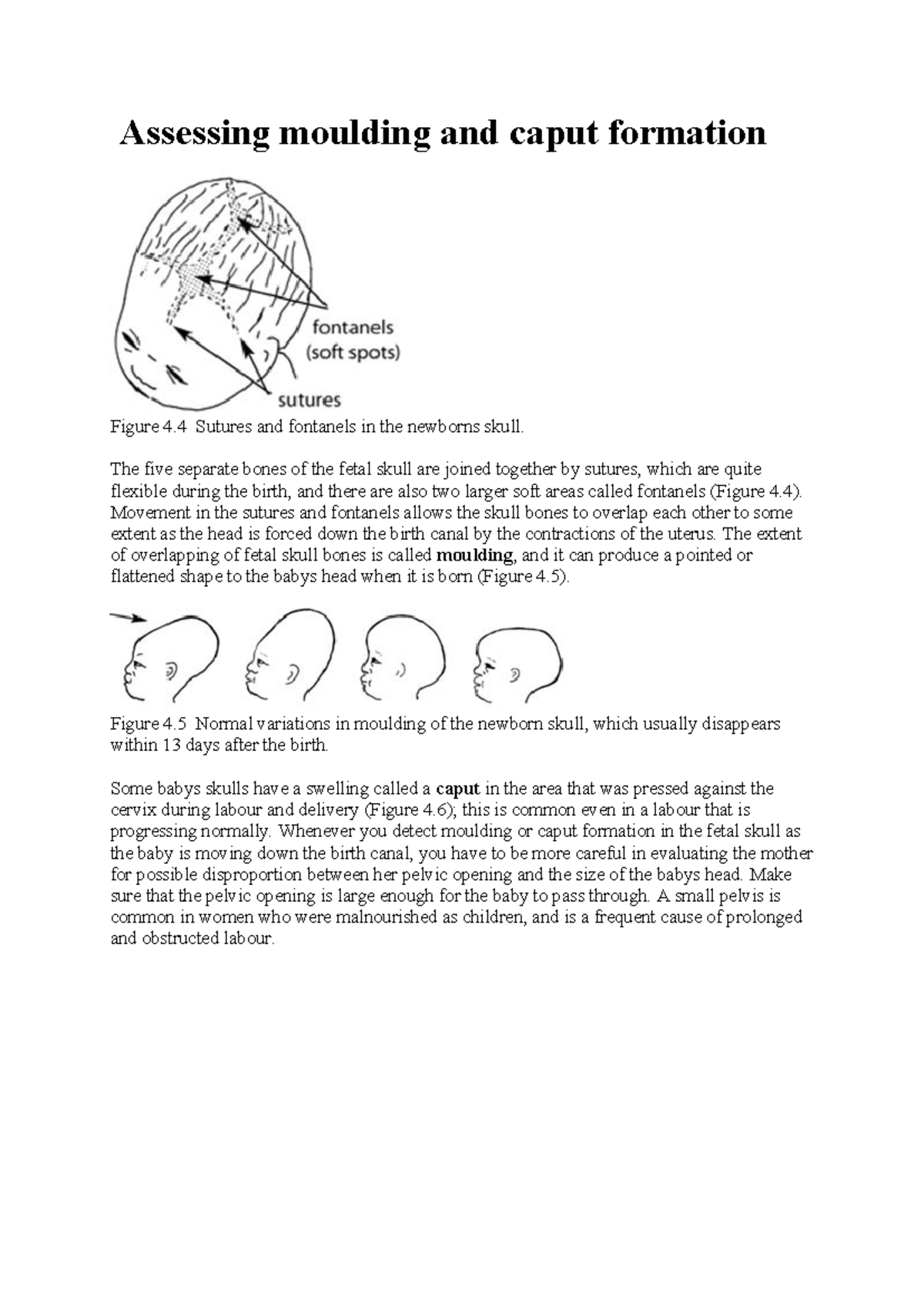 Assessing moulding and caput formation - The five separate bones of the ...