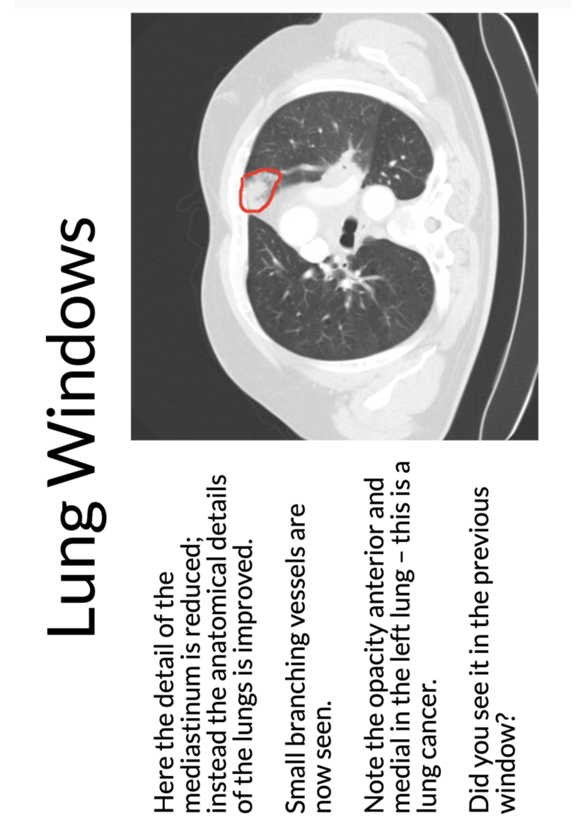 Lung CT - lung ct explanation - MD3001 - Lung Windows Here the detail ...