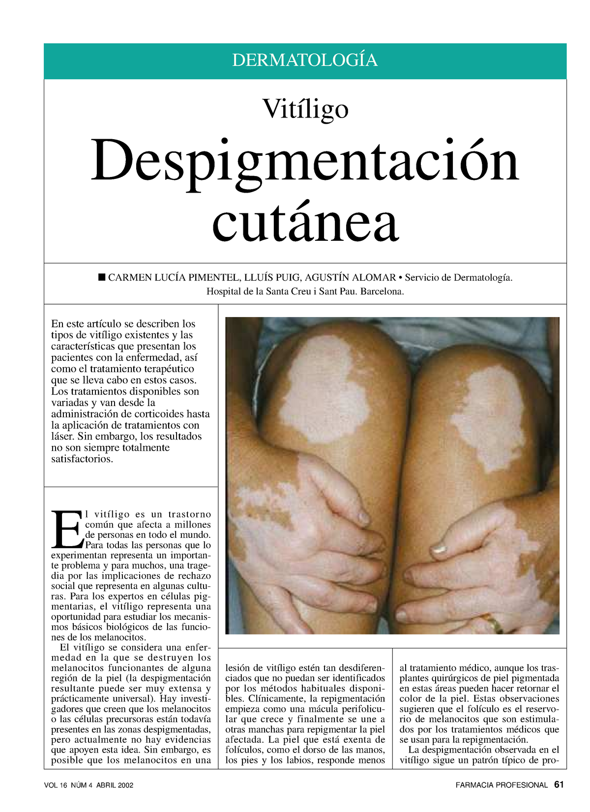 Vitíligo. Despigmentación cutánea - DERMATOLOGÍA En este artículo se  describen los tipos de vitíligo - Studocu