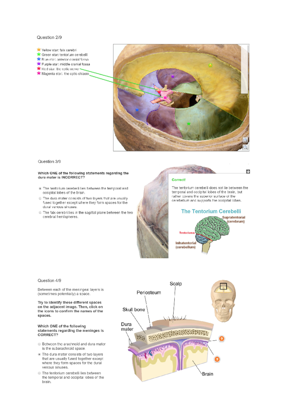 Adaptive Tutorial Meninges Ventricles Answers - ANAT2111 - Studocu