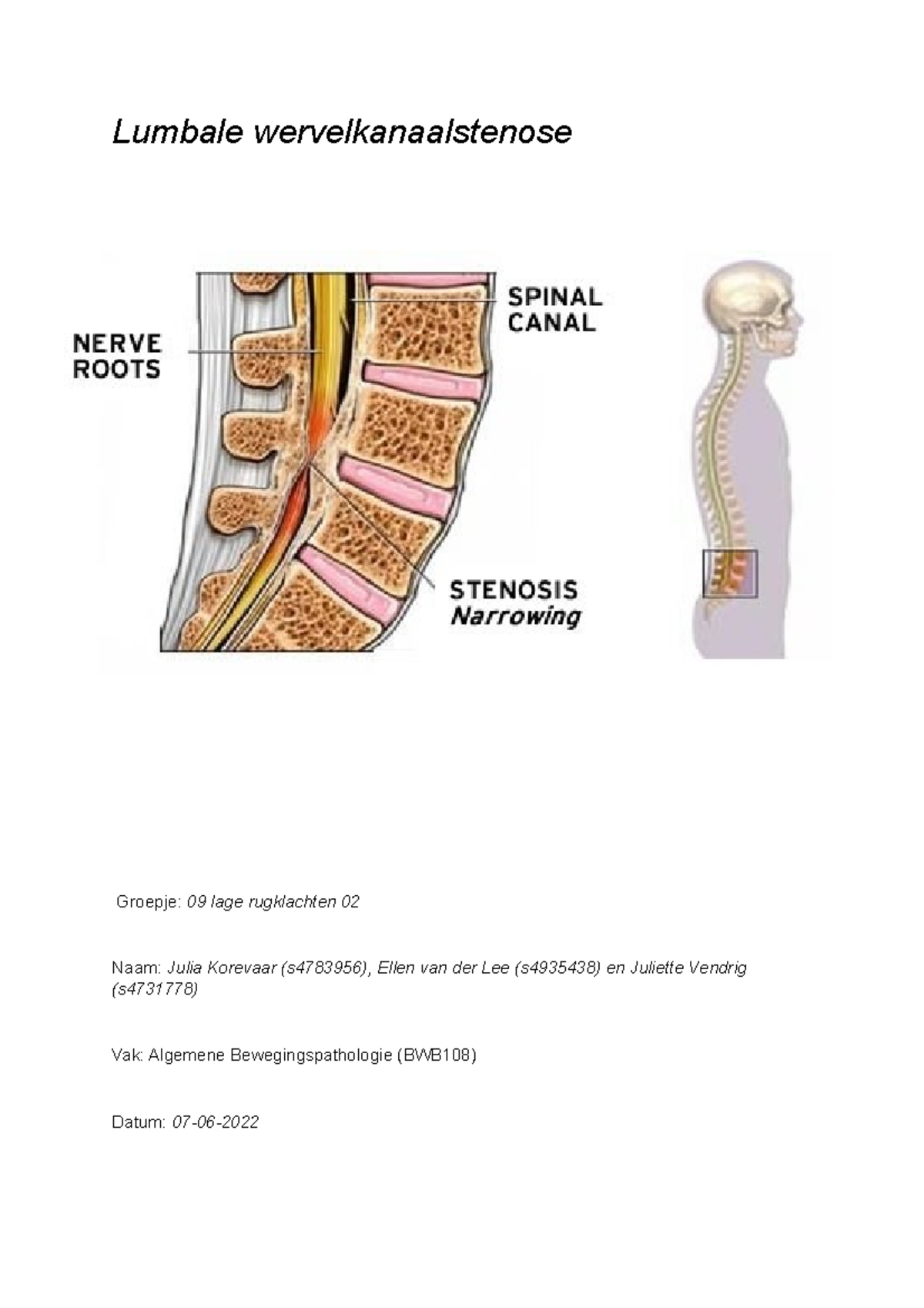 09 Lage Rugklachten 02 - Lumbale Wervelkanaalstenose Groepje: 09 Lage ...