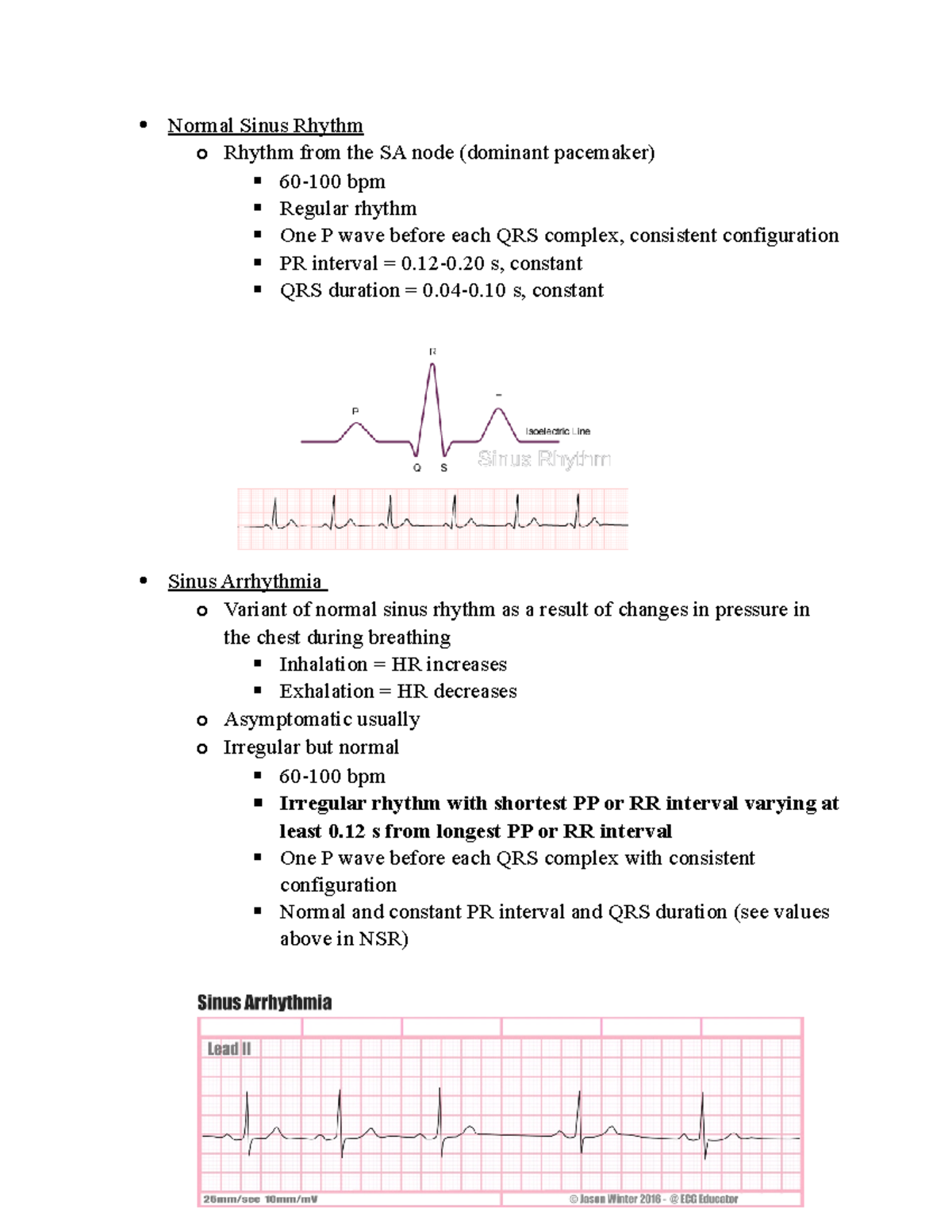 Atrial Dysrhythmias - Normal Sinus Rhythm o Rhythm from the SA node ...