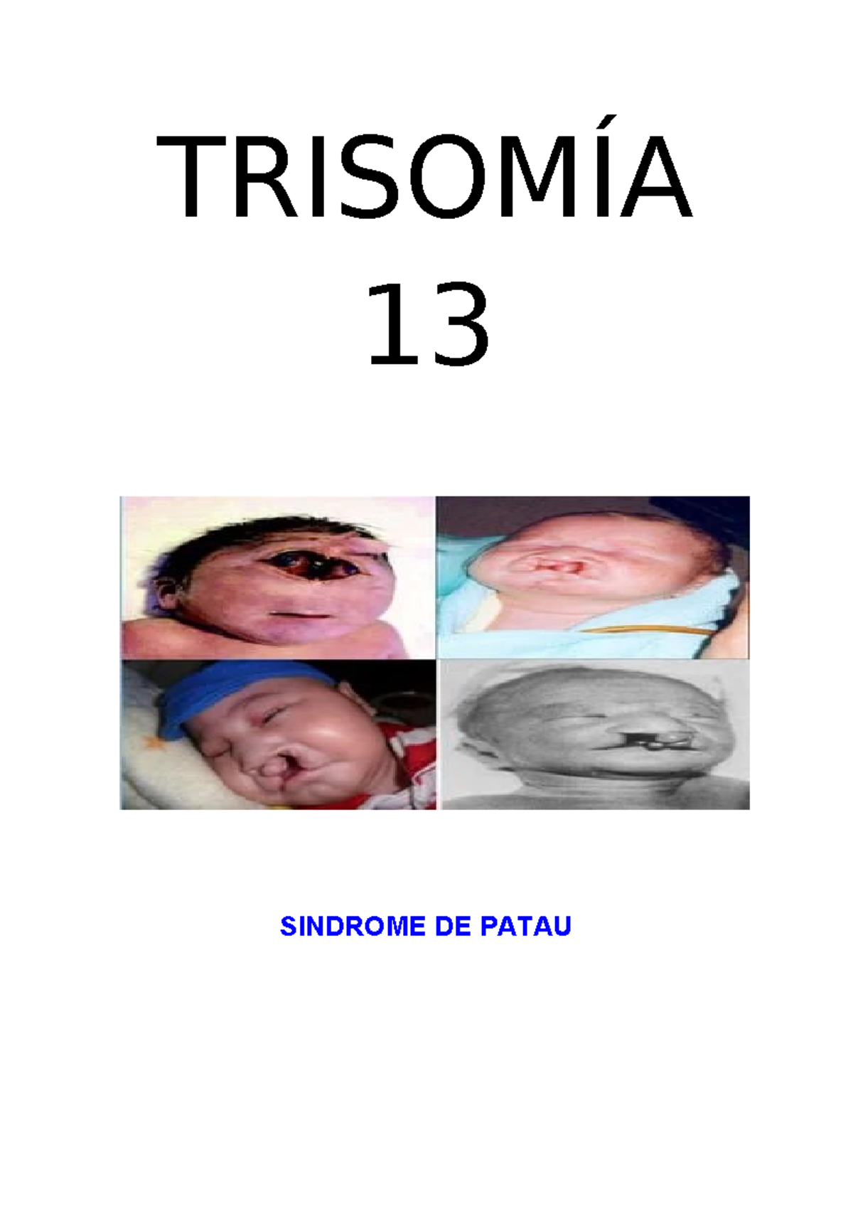 Trisomia 13 - TRISOMÍA 13 SINDROME DE PATAU ####### “AÑO DE LA UNIDAD ...