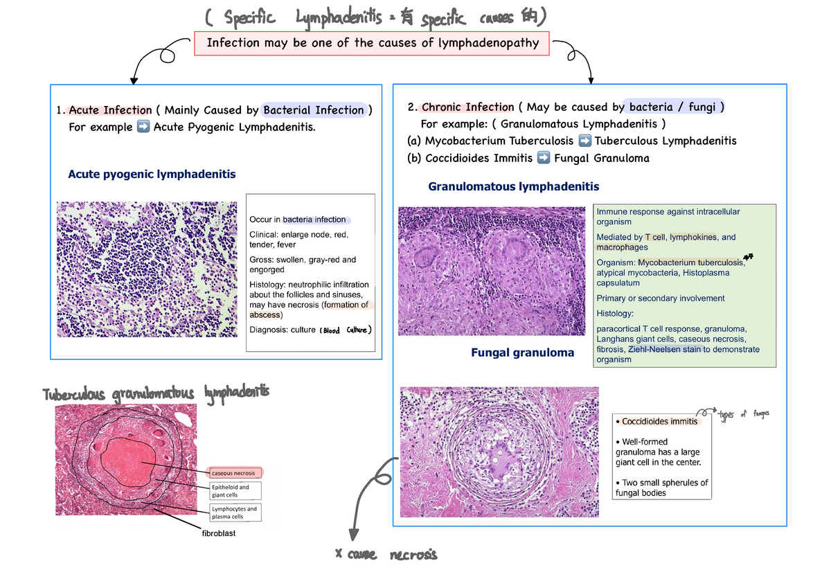 Lymphadenitis Lymphoma Acute Infection Mainly Caused By Bacterial 