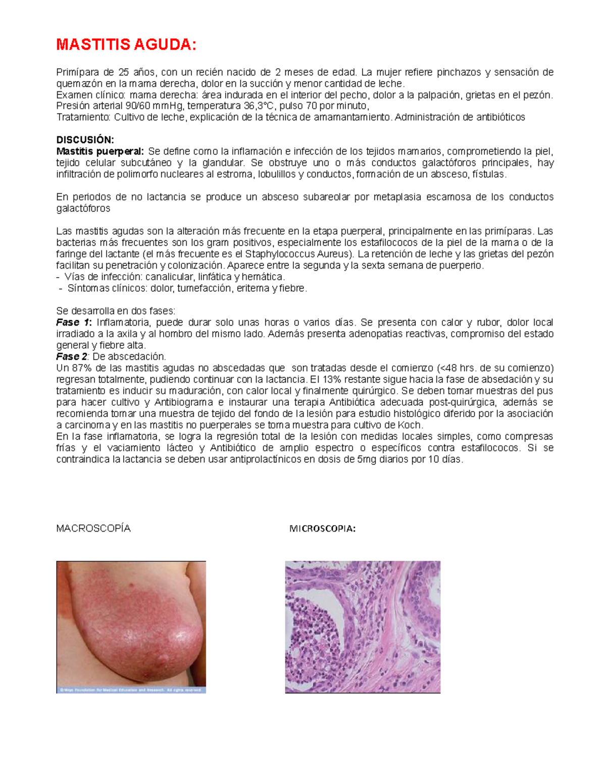 Mastitis aguda Apuntes 1 MASTITIS AGUDA Primípara de 25 años, con