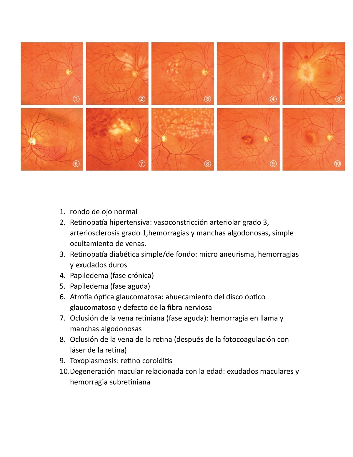 retinopatía hipertensiva vs normal