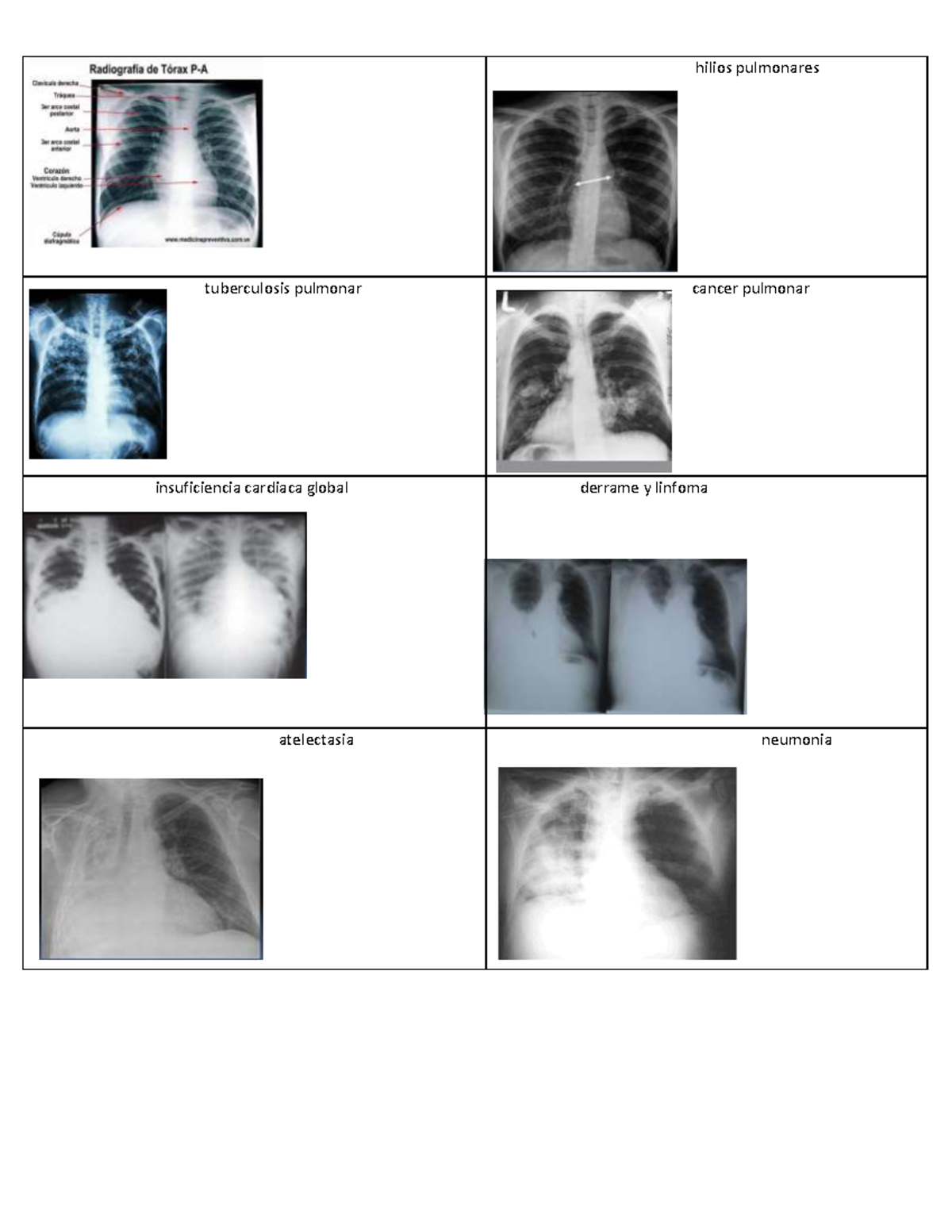 Hilios pulmonares - Radiografías descriptivas - Neumología - hilios ...