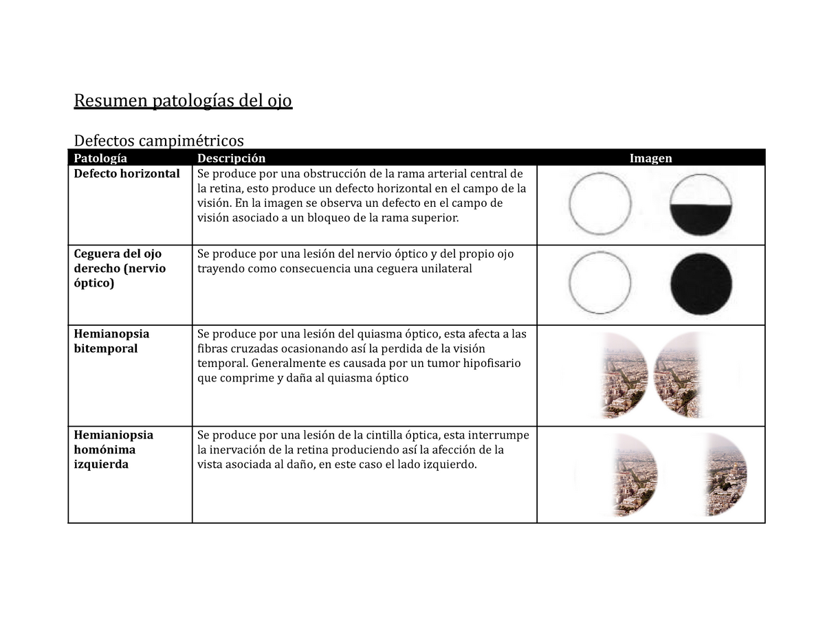 cuadrantanopsia superior