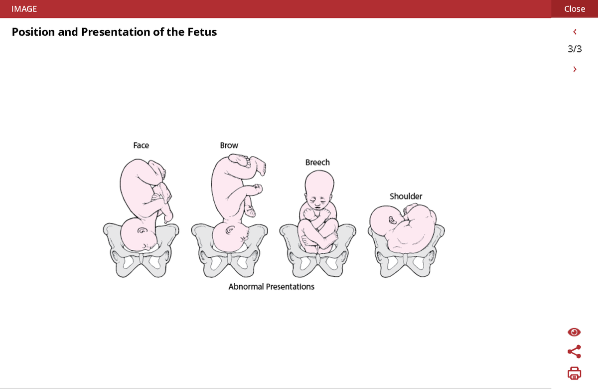 abnormal presentation of fetus slideshare