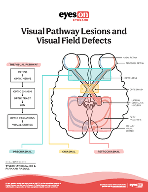 Visual Pathway & Visual Field Defects - THE VISUAL PATHWAY PRECHIASMAL ...